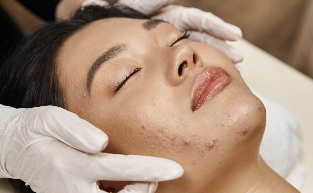Acne Relief