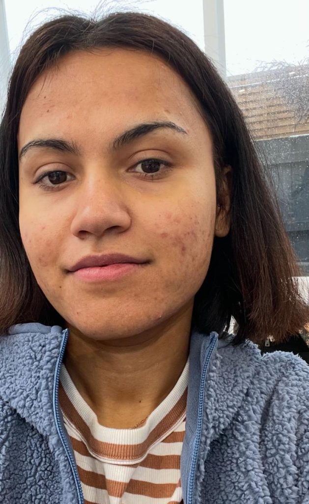 Sabina at the beginning of her skin journey