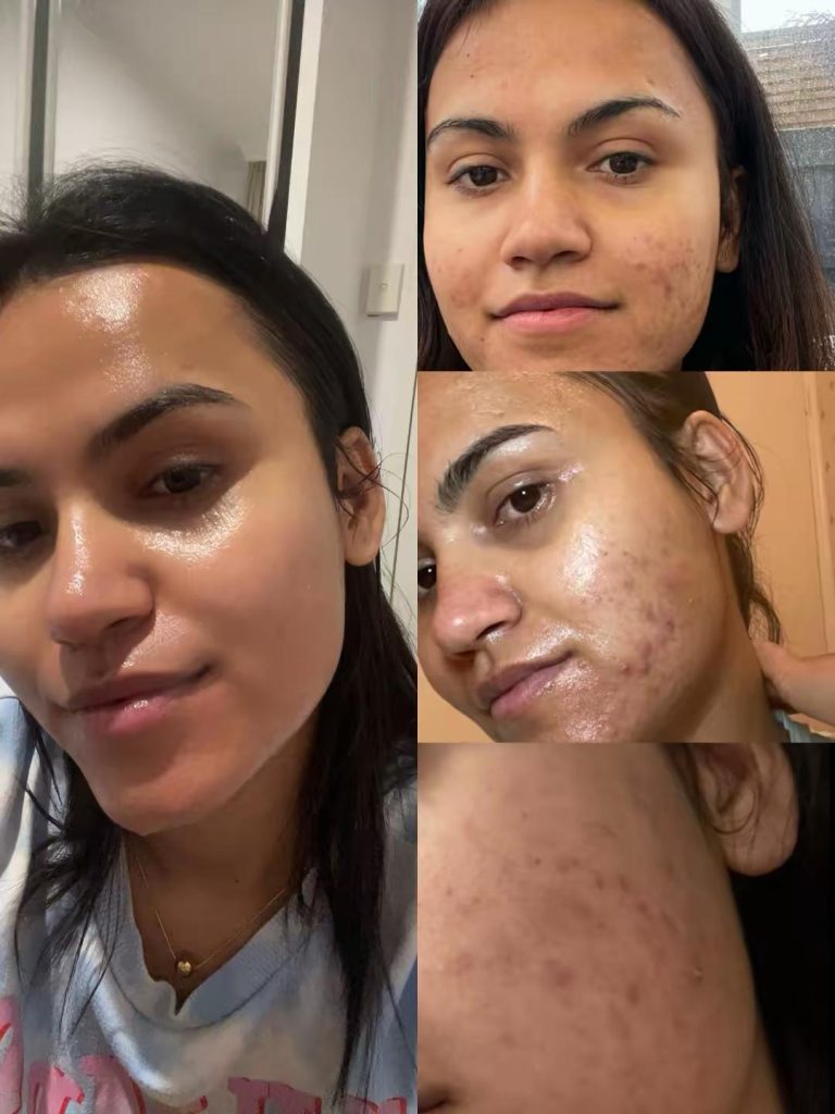 Clear, healthy skin after the transformation